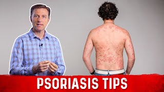 How to Get Rid of Psoriasis – Natural Remedies for Psoriasis by DrBerg [upl. by Nelram]