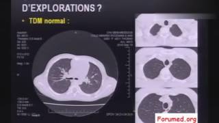 Cas Cliniques en images sur la fibrose pulmonaire idiopathique et pneumopathie [upl. by Wolbrom]