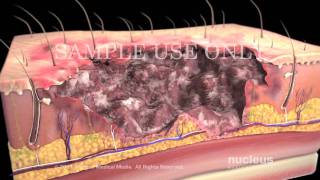 Burns Classification and Treatment [upl. by Woodsum]