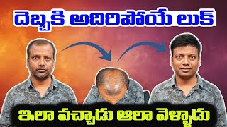 దెబ్బకు అదిరిపోయే లుక్ hair replacement  hair patch fixing  hair patch for men hair patch [upl. by Lednahs]