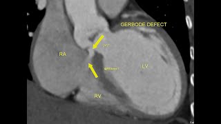 Gerbode defect [upl. by Suzie]