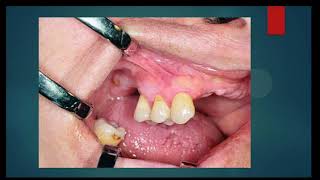 Oral Surgery L1 Preprosthetic Surgery [upl. by Ahsed]