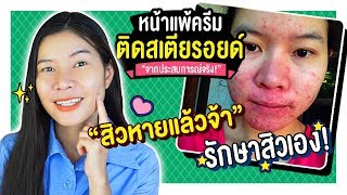 หน้าแพ้ครีม ติดสารสเตียรอยด์ รักษายังไง🔔ประสบการณ์รักษาสิวเองจากเต็มหน้าจนหาย แนน Sister Nan [upl. by Orlando]