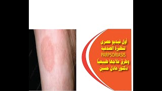 أول فيديو حصرى لنظيرة الصدفية PARAPSORIASIS وطرق علاجها طبيعياً دكتورعادل حسين [upl. by Natika]