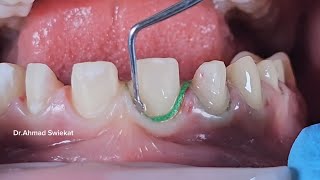 replacing first Retraction cord and finishing and contouring before the final impression [upl. by Nyliram]