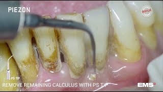 Guided Biofilm Therapy Step 06 Calculus removal with PIEZON® and the PS instrument [upl. by Darnok]