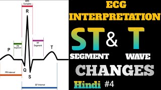 ECG interpretation in hindi  how to read ecg in hindi  ST and T Wave Changes interpretation  4 [upl. by Yasmeen92]