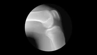 Knee XRay Negative [upl. by Yanal]