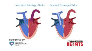 Tetralogy of Fallot Repair [upl. by Edualcnaej23]