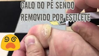 Remoção de Calo GIGANTE De Dedo Do Pé  ASMR GIANT Callus Removal [upl. by Anirbak580]