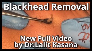 Deep Blackhead Removal by DrLalit Kasana  New Blackhead Video [upl. by Anisirhc835]