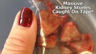 Massive Kidney Stones Caught On Tape Must See [upl. by Fleming650]