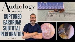 RUPTURED EARDRUM  SUBTOTAL PERFORATION  EP489 [upl. by Kries308]