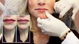 30 Units of Botox  Lip Filler from Doctor Cynthia Cote [upl. by Ethelstan757]