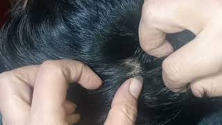 Scalp Check Real Person  Lice And Nits Checking ASMR  Mousaasmr830 [upl. by Irol154]