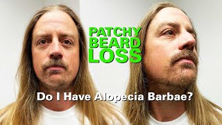 Patchy Beard Loss Do I Have Alopecia Barbae [upl. by Nnylatsyrc]