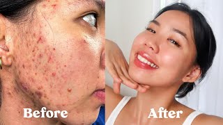 ENG SUB HOW I GOT RID OF MY ACNE SCARS TEXTURE amp HYPERPIGMENTATION not sponsored [upl. by Ennovad]