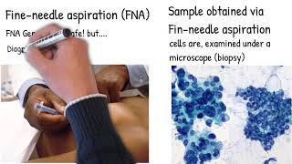 Needle Biopsy FNA is really safe  Cancer spreading risk You should be informed of the risk [upl. by Nevin251]