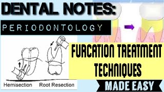 FURCATION INVOLVEMENT PART2 II DENTAL NOTES II PERIODONTOLOGY II TREATMENT PROCEDURES MADE EASY [upl. by Itra506]