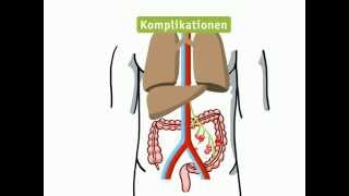 Kolonkarzinom  Lehrvideo [upl. by Anselme]