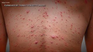 Doctors issue warning about chicken pox parties [upl. by Klinges]