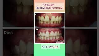 Say Bye Bye to Teeth Gaps with GapAligner Dr Srishti Bhatia [upl. by Ennagem729]