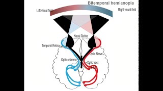 Lesion at the Optic chiasma and Bitemporal Heteronymous Hemianopia [upl. by Bausch]