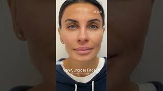 NonSurgical Facelift [upl. by Euqor]