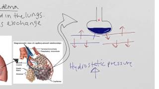 Immersion pulmonary edema [upl. by Groveman]