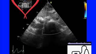 Ultrasound Board Review on Situs Inversus Corrected Transposition of the Great Arteries Ped Echo [upl. by Woody]