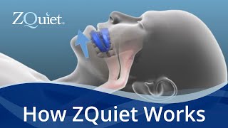 Want to Stop Snoring Learn How ZQuiet Anti Snoring Mouthpieces Work [upl. by Edvard]