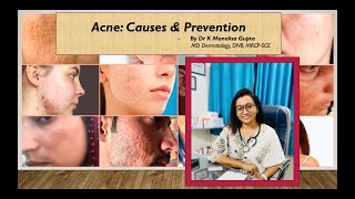 Acne Causes amp Prevention  Clear Skin Tips from a Dermatologist [upl. by Arret]