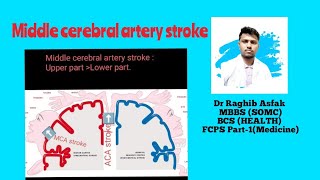 Middle cerebral artery Stroke by Dr Raghib Asfak [upl. by Hitoshi]