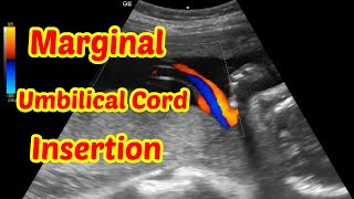 Marginal Umbilical Cord Insertion [upl. by Nyahs]