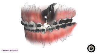 Impacted Canine Aurora Orthodontics [upl. by Nazar]