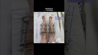 猿でもわかる骨延長 骨延長 身長 leglengthening limblengthening shorts [upl. by Nerro]