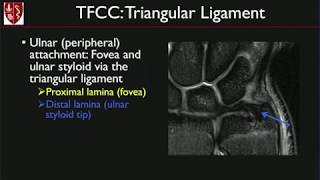 MRI of the Wrist Ligaments and Triangular Fibrocartilage Complex by Michelle Nguyen MD [upl. by Geithner980]