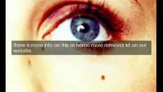 Freeze Mole Removal At Home [upl. by Aerdnu581]