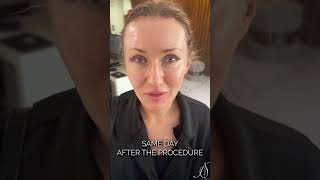 Blepharoplasty 1 Month After [upl. by Llenad]