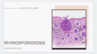 RHINOSPORIDIOSIS [upl. by Alejandro]