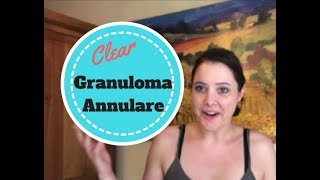 How my Granuloma Annulare Cleared Up [upl. by Ludovick]