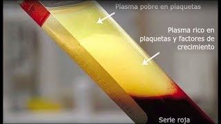 Plasma rico en fibrina para una mejor recuperación y cicatrización de heridas [upl. by Eaves]