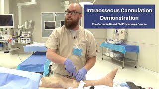 Intraosseous Cannulation Demonstration  The CadaverBased EM Procedures SelfStudy Course [upl. by Jodoin278]