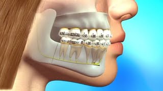 Quick straight teeth Braces How does Braces work process of Getting Braces  Amazing tooth [upl. by Edlyn]