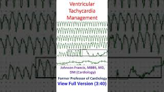 Ventricular Tachycardia Management [upl. by Htnamas747]