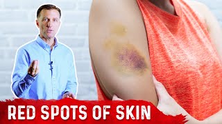 What Causes Bruises on Legs amp Arms – Top 5 Causes of Bruising Covered by DrBerg [upl. by Westfahl444]