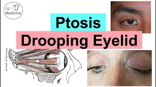 Ptosis Drooping Eyelid  Eye Anatomy Causes Associated Conditions Diagnosis amp Treatment [upl. by Medarda257]