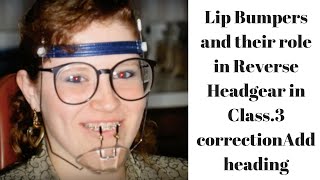 Lip Bumpers and their role in Reverse Headgear in Class3 correction [upl. by Bullock245]