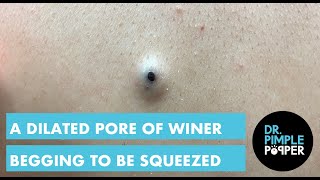 A Dilated Pore of Winer that is Begging to be Squeezed [upl. by Ikkir359]