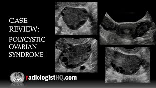 Ultrasound of Polycystic Ovarian Syndrome [upl. by Kajdan945]